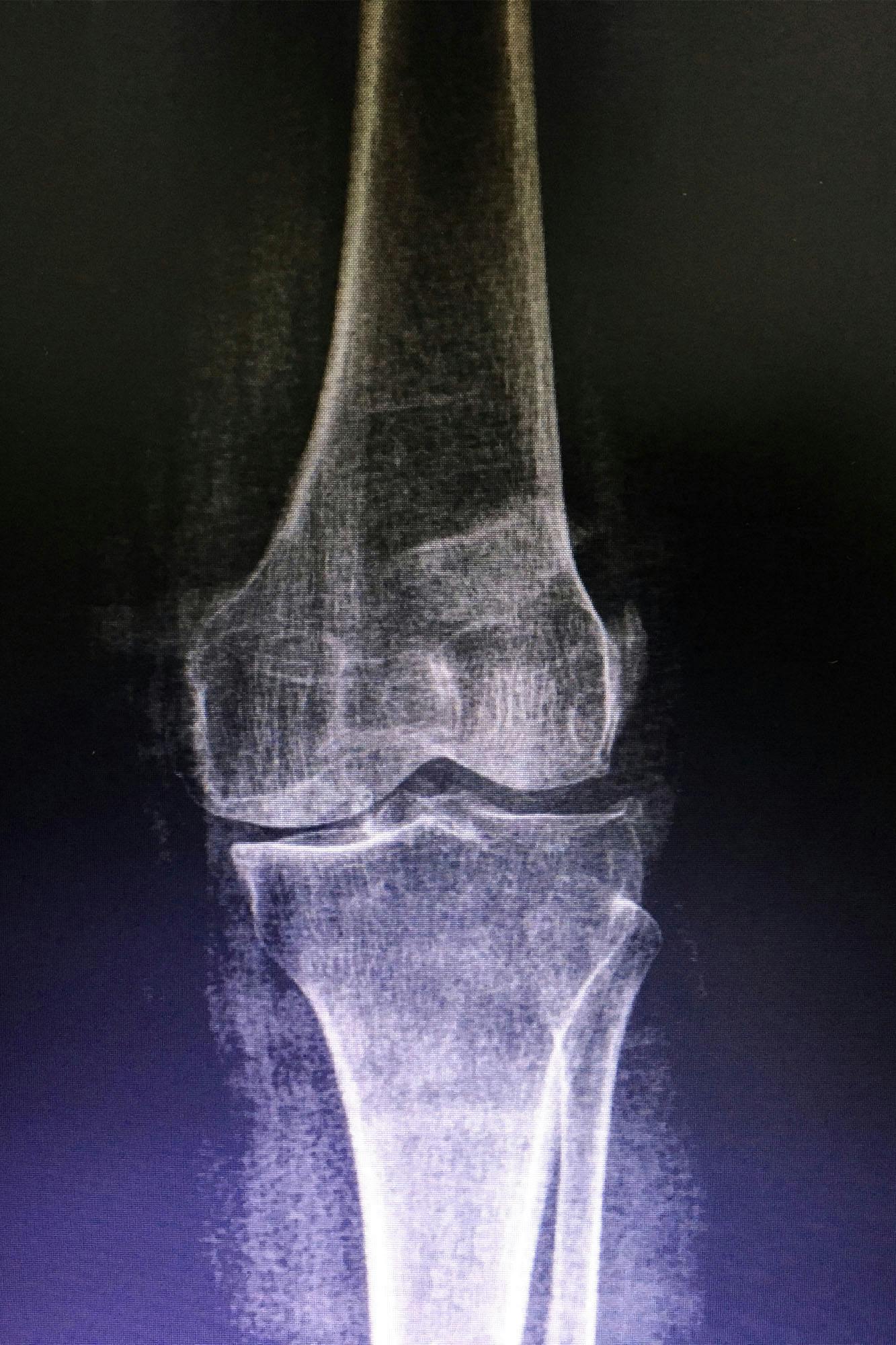 an-x-ray-of-the-knee-bone-area-with-pain_roentgenbild-knie_verletzung