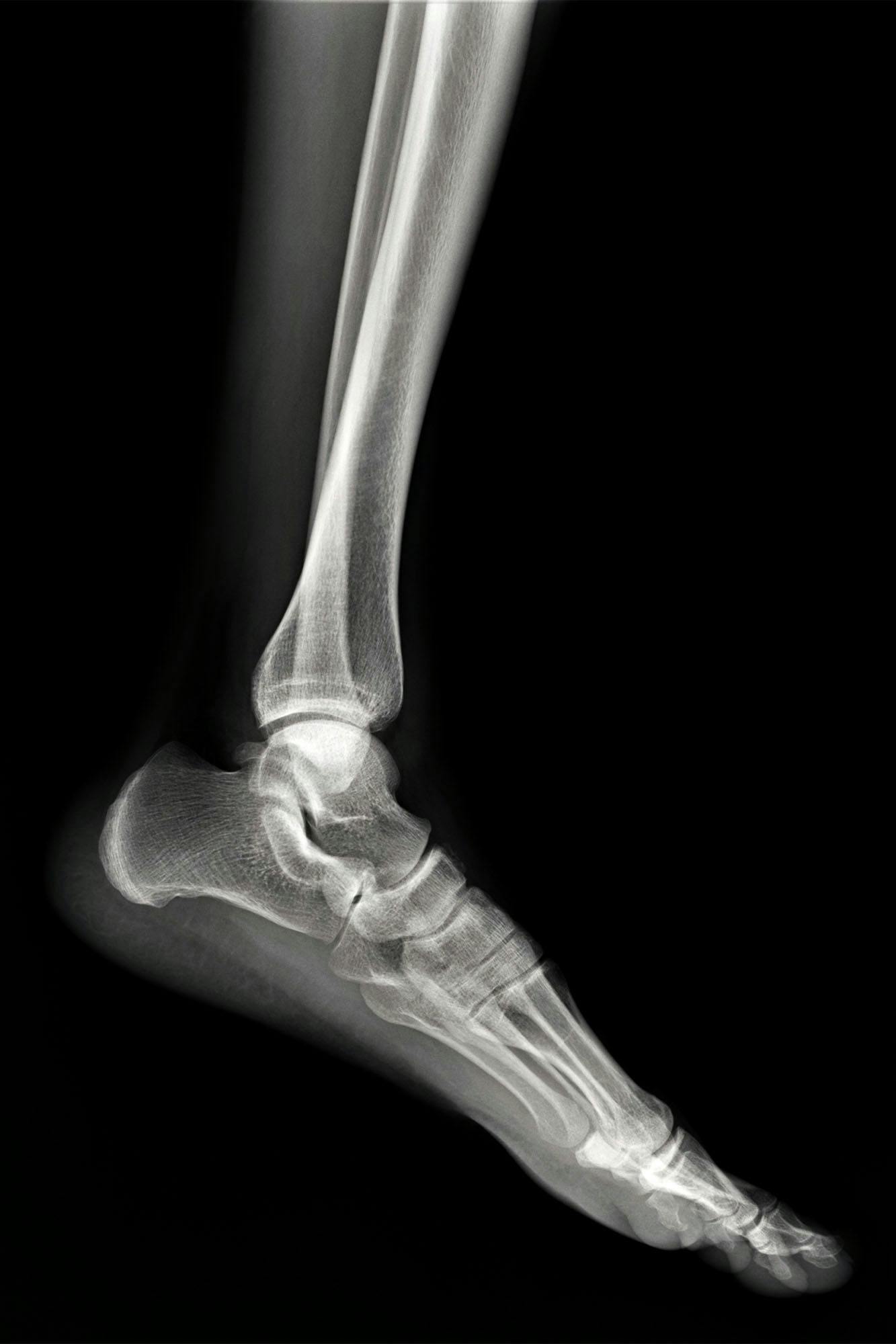 normal-radiography-of-the-ankle-joint-in-the-lateral-projection_roentgenbild-fuss